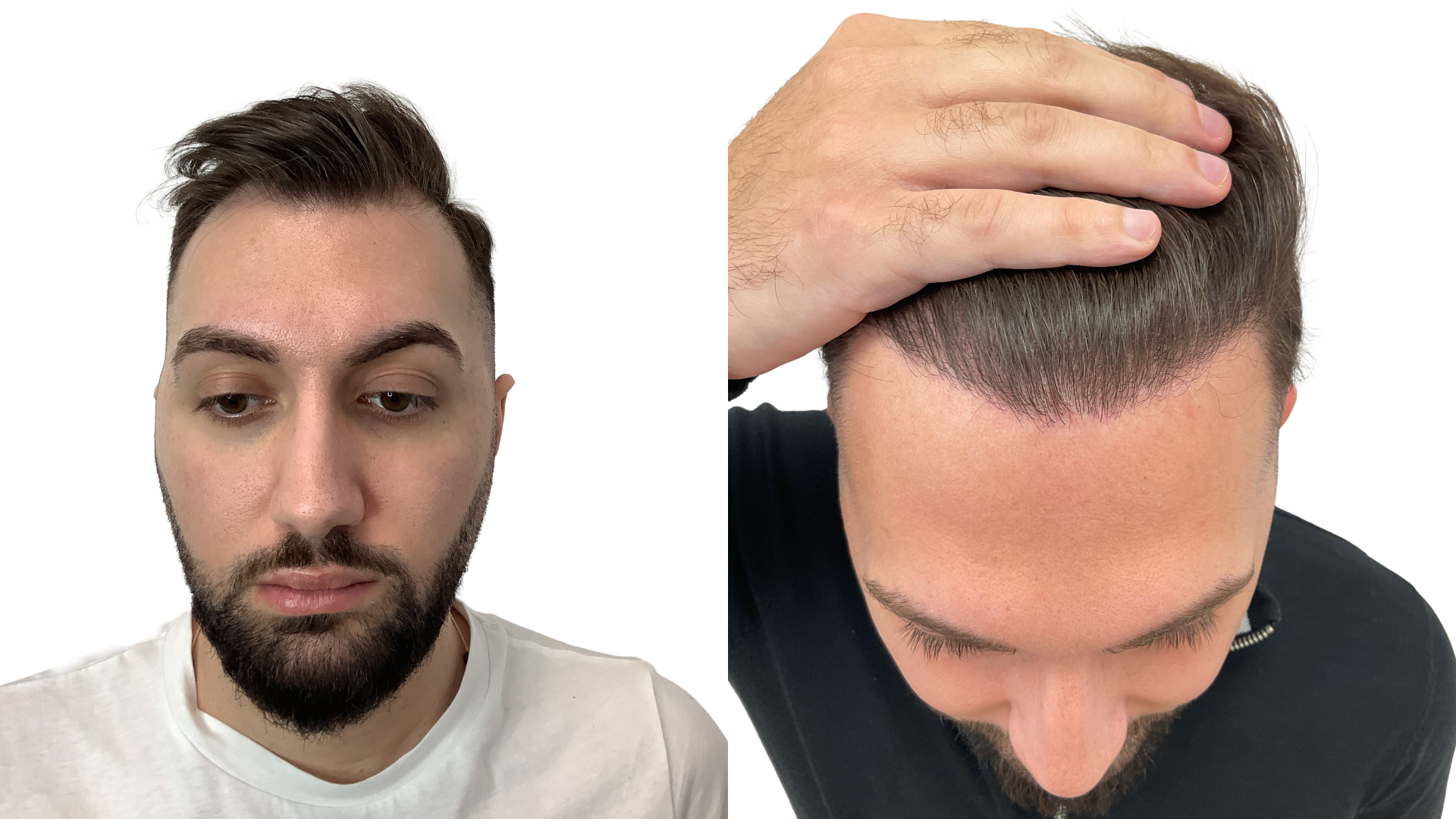 Simon – före och efter sin hårtransplantation