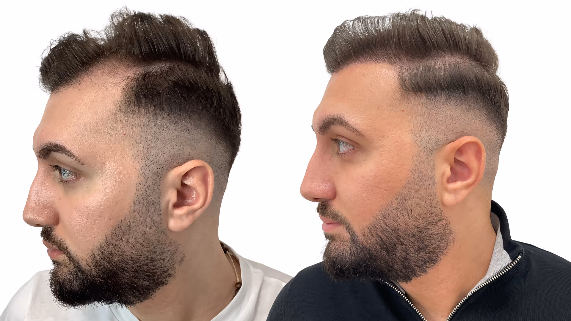 Simon – före och efter sin hårtransplantation