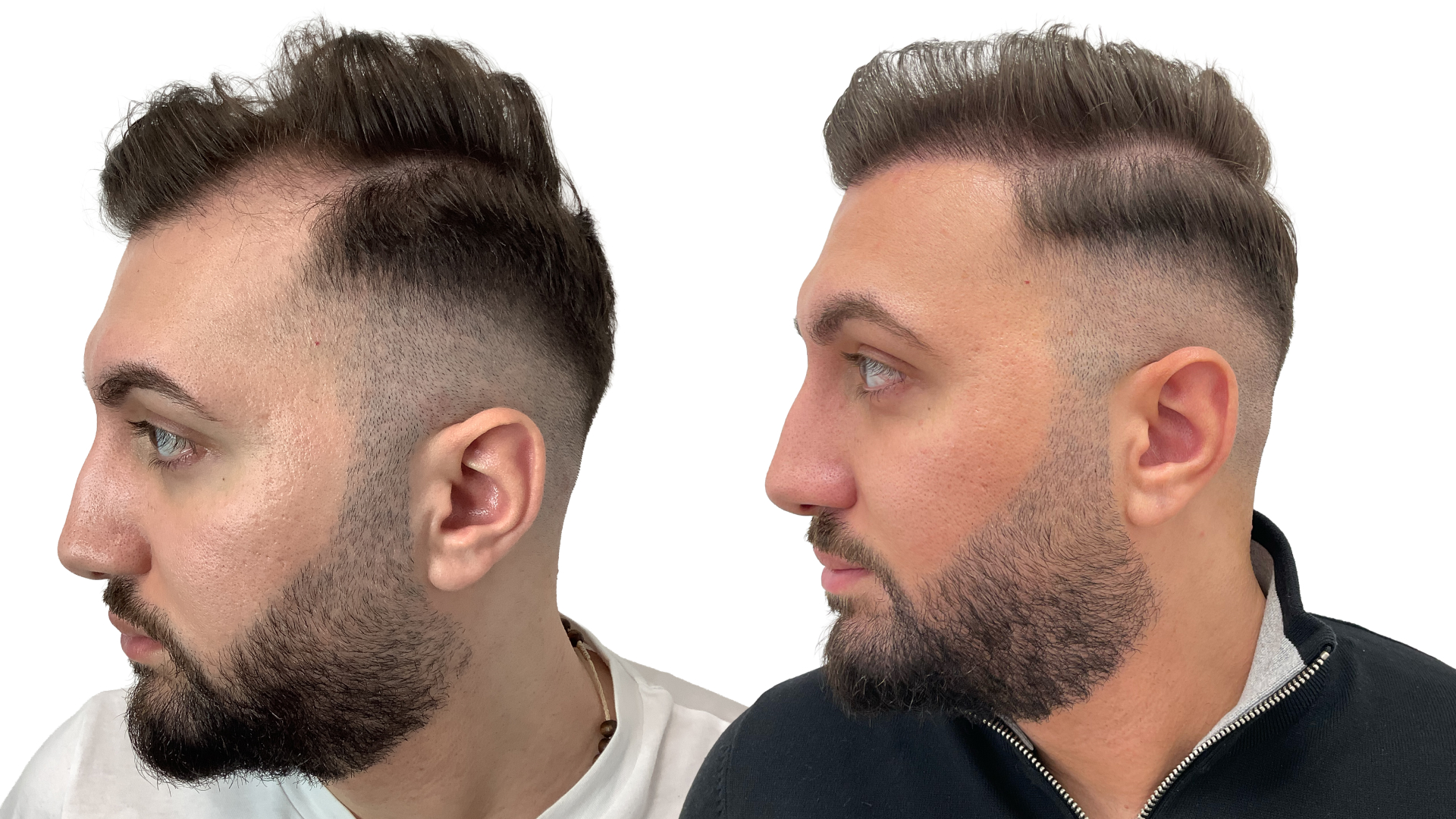 Simon – före och efter sin hårtransplantation