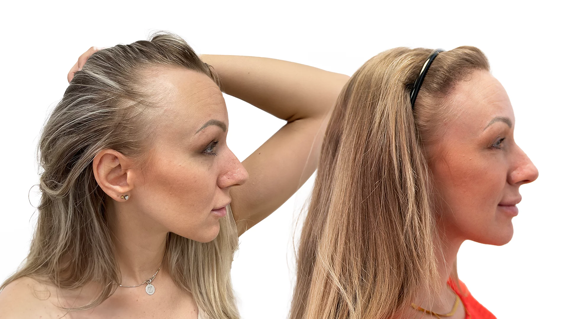 Sandra – före och efter sin hårtransplantation