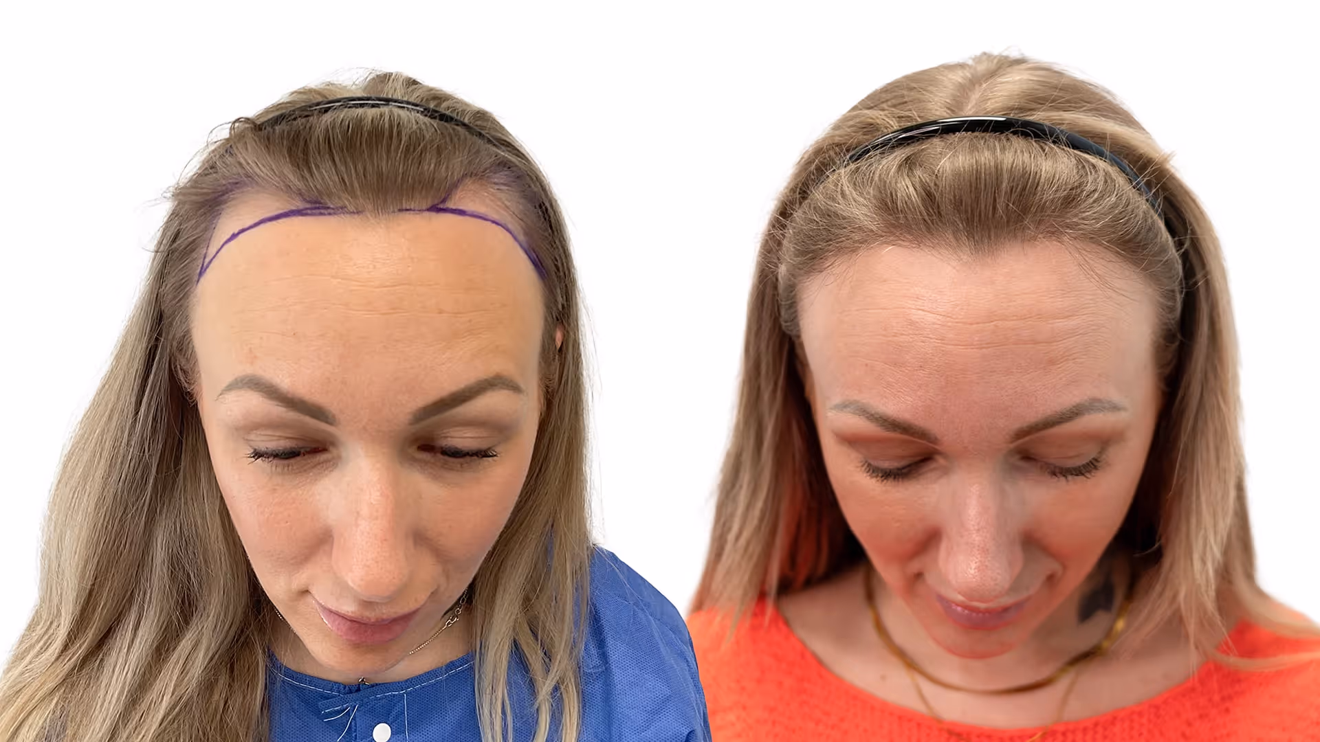 Sandra – före och efter sin hårtransplantation