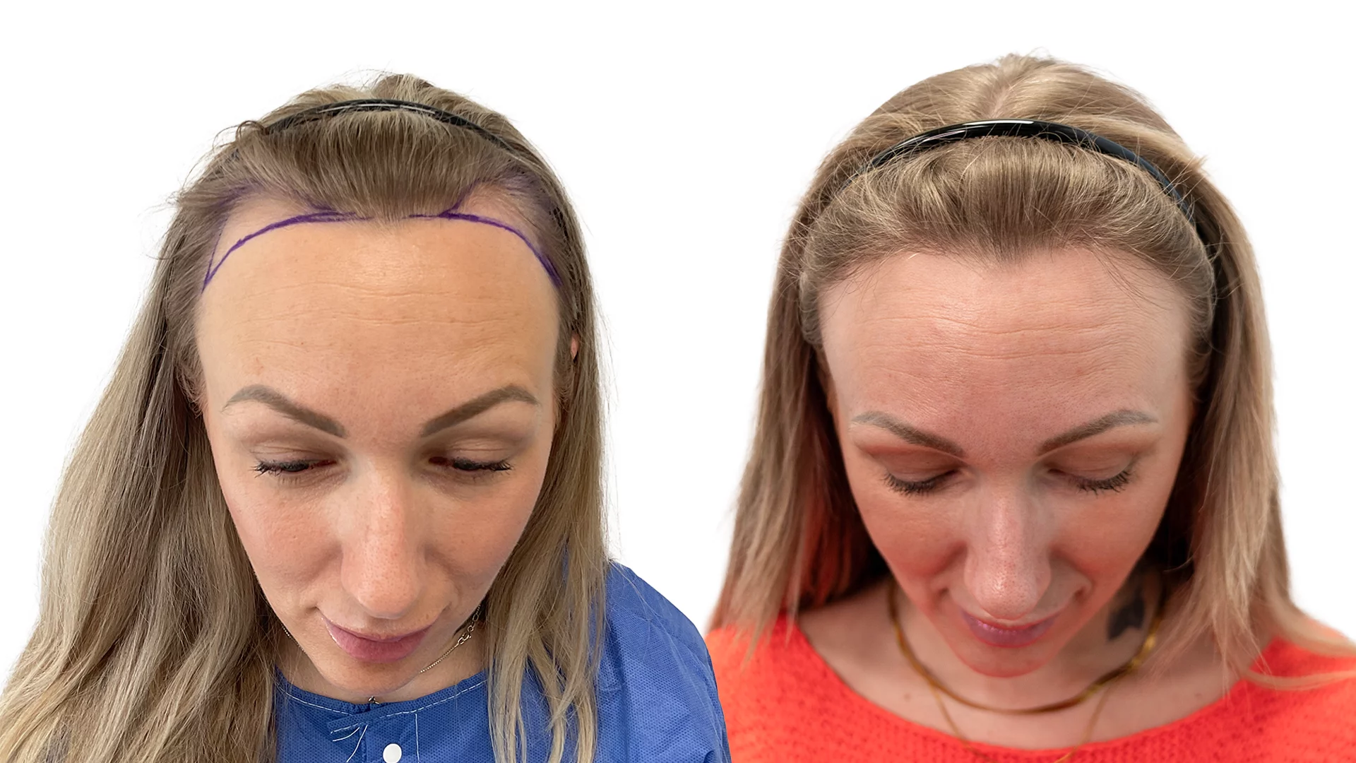 Sandra – före och efter sin hårtransplantation