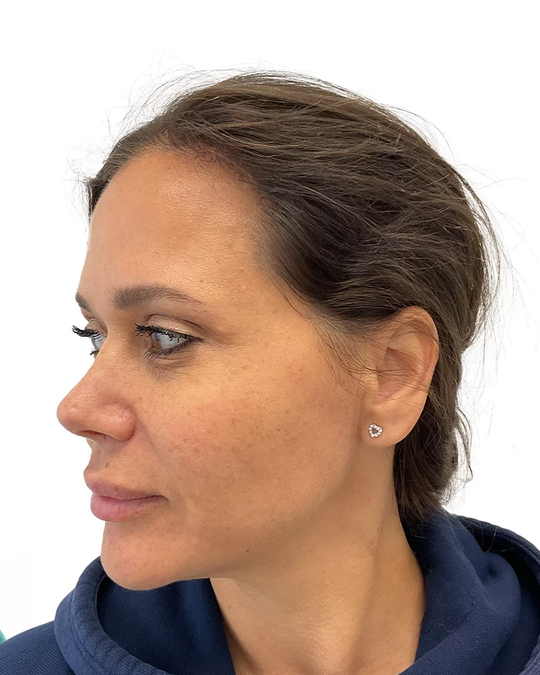 Sandra efter hårtransplantationen