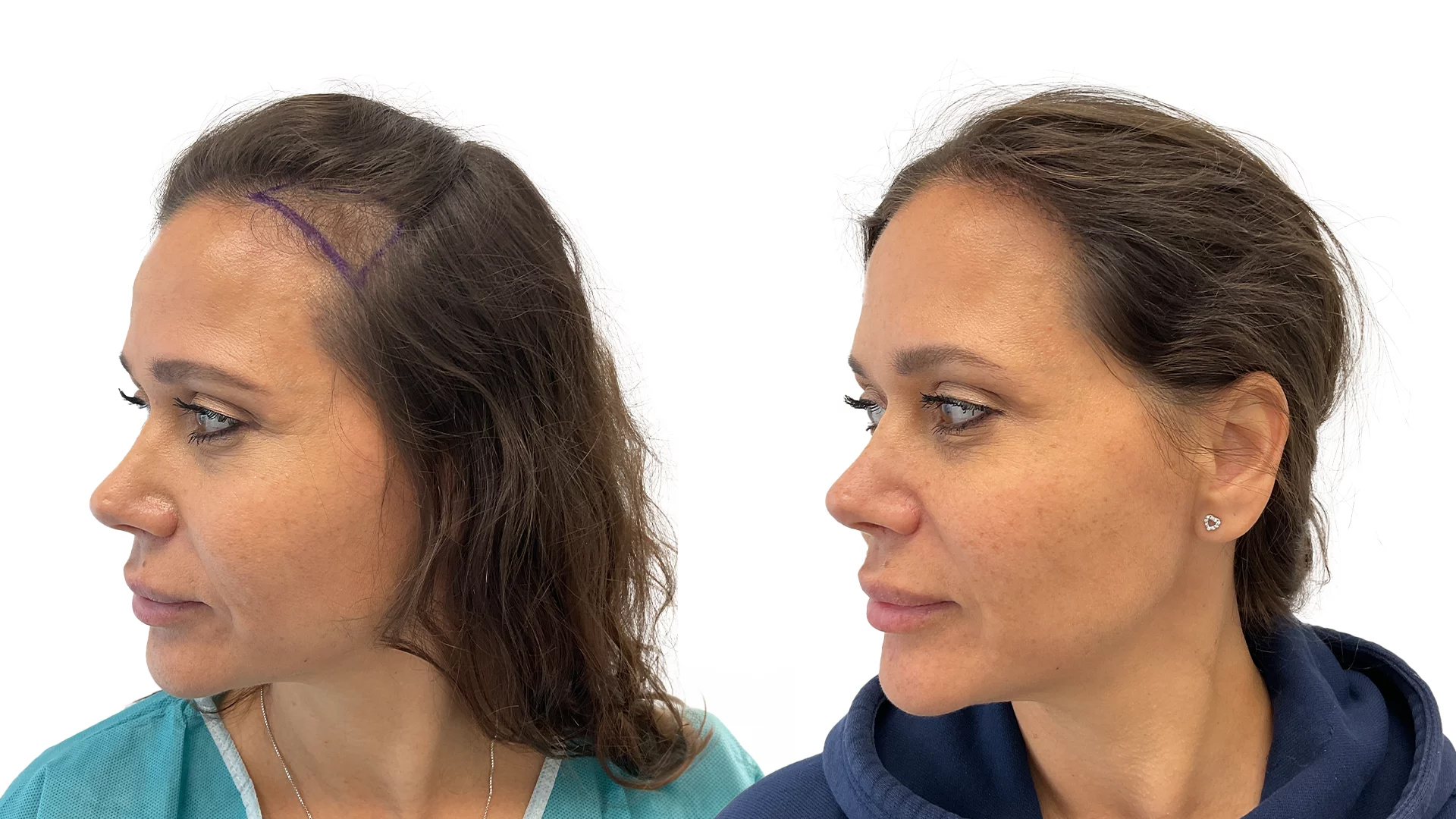 Sandra – före och efter sin hårtransplantation
