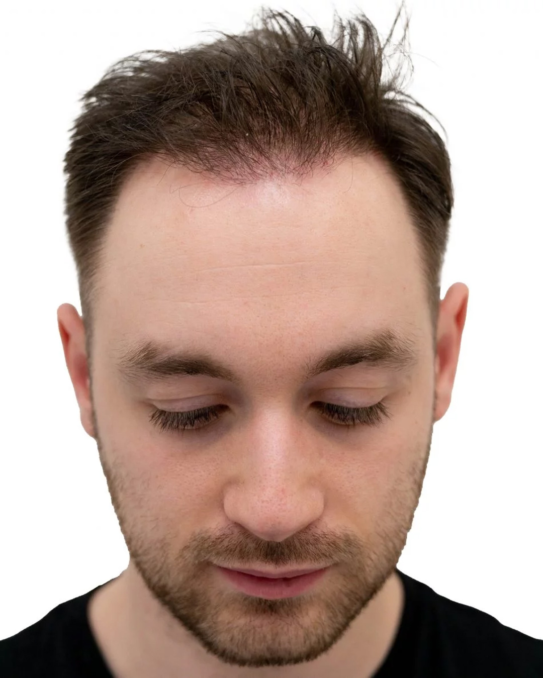 Robert efter hårtransplantationen