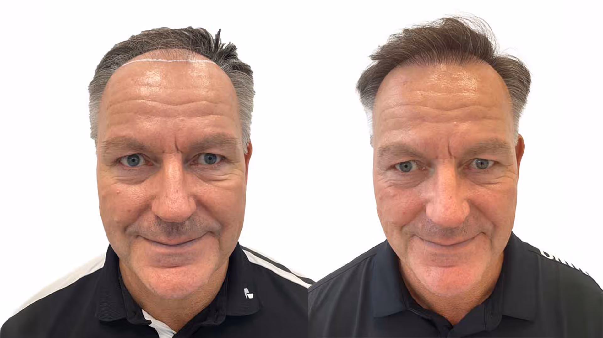 Rene – före och efter sin hårtransplantation