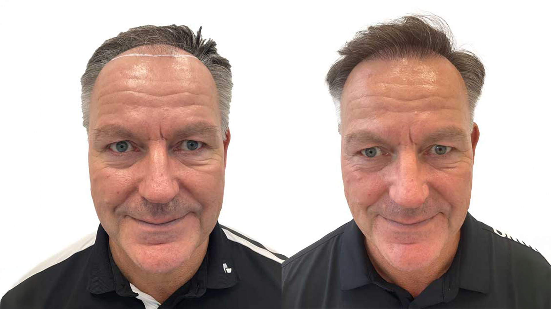 Rene – före och efter sin hårtransplantation