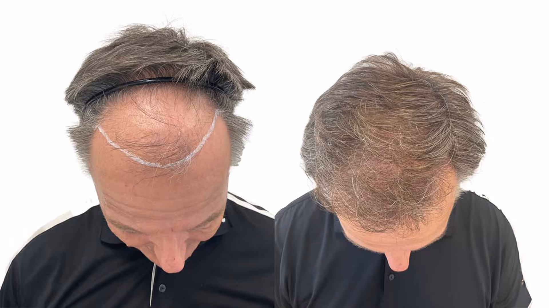 Rene – före och efter sin hårtransplantation