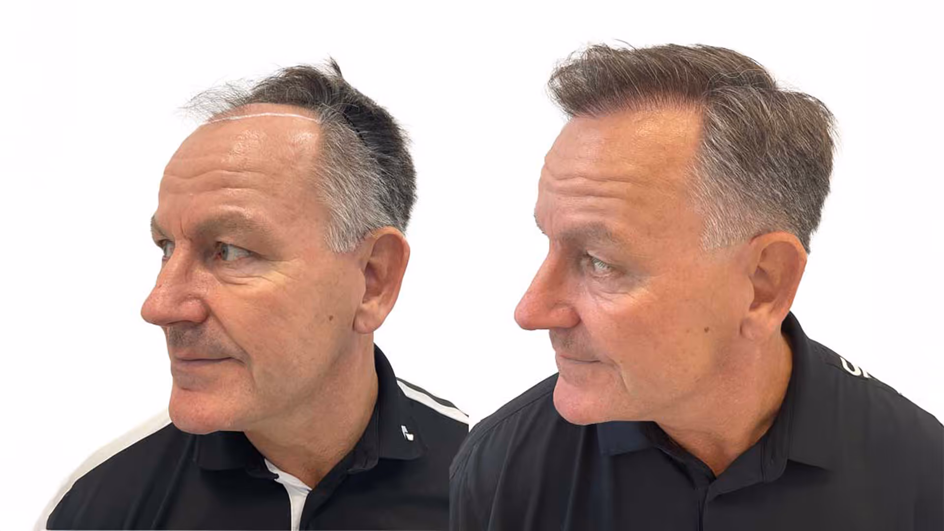 Rene – före och efter sin hårtransplantation
