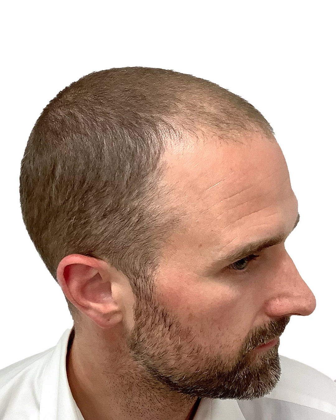 Pontus före hårtransplantationen