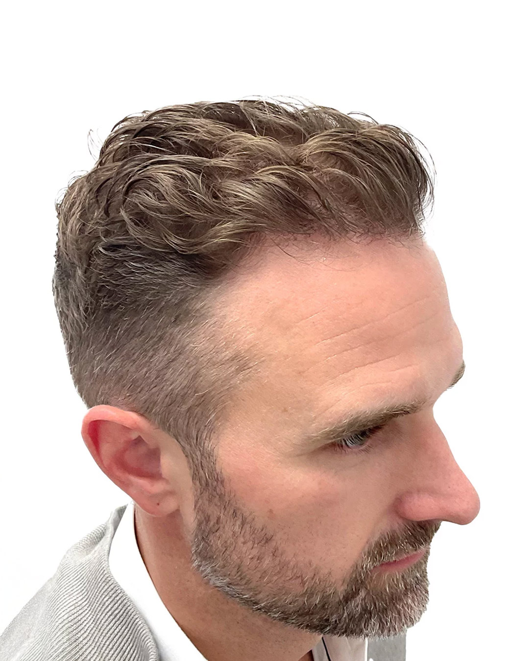 Pontus efter hårtransplantationen