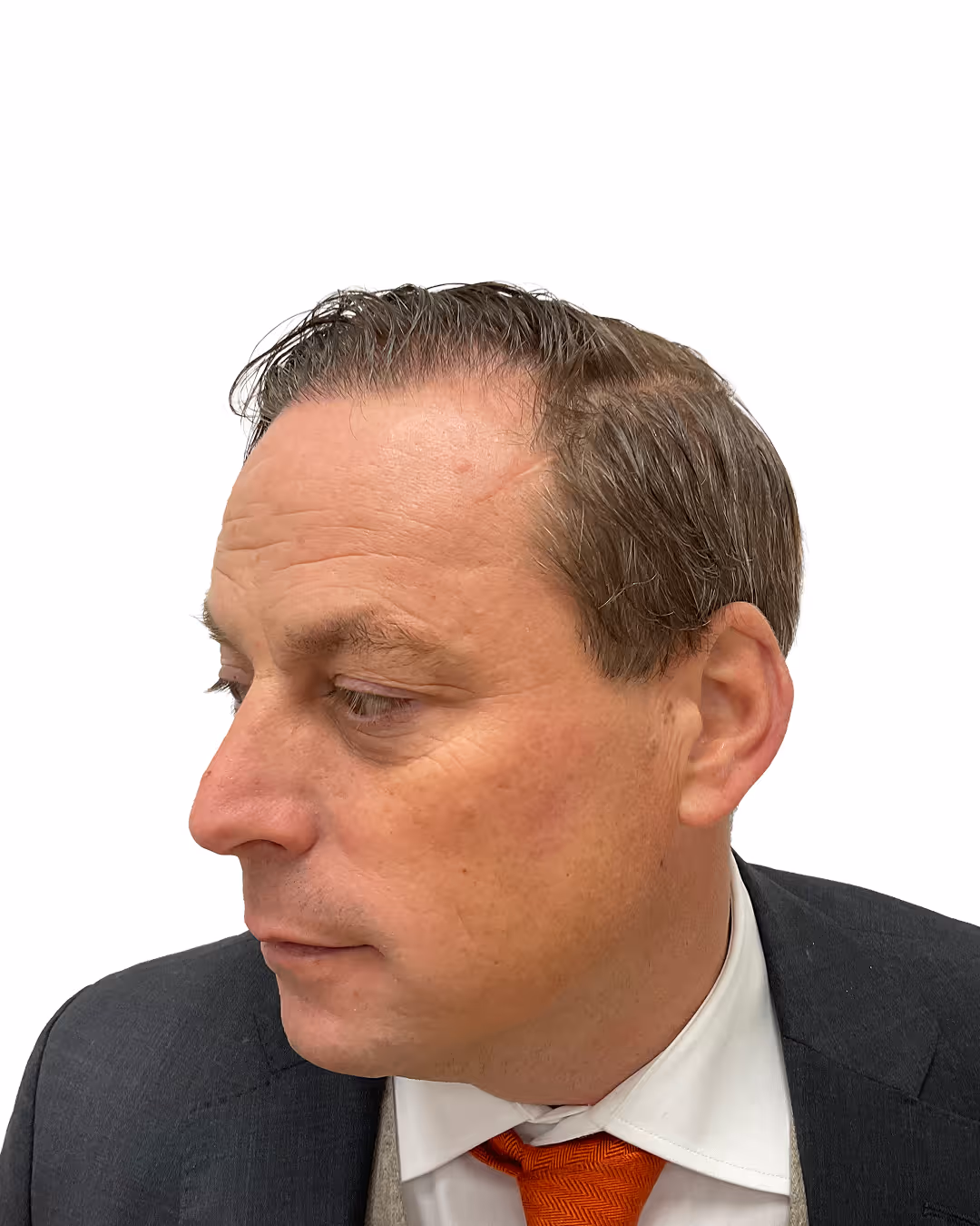Per efter hårtransplantationen