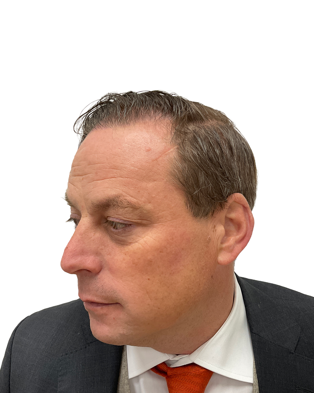 Per efter hårtransplantationen