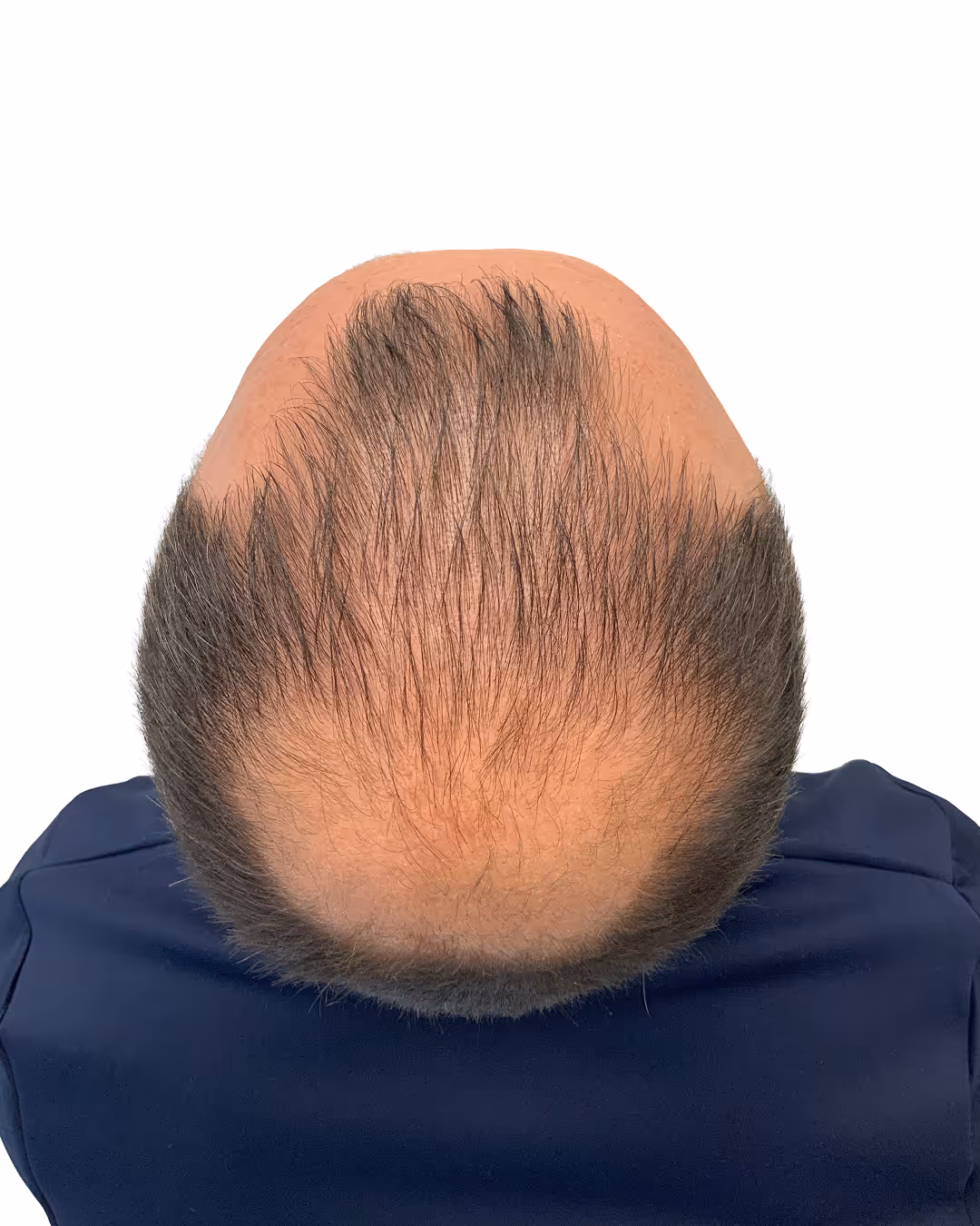 Massimo före hårtransplantationen