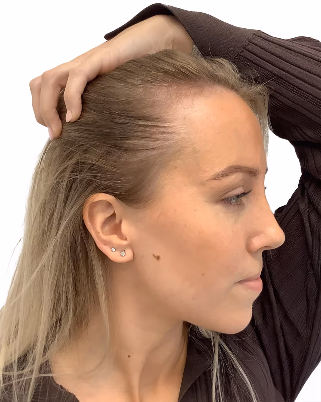 Martina före hårtransplantationen