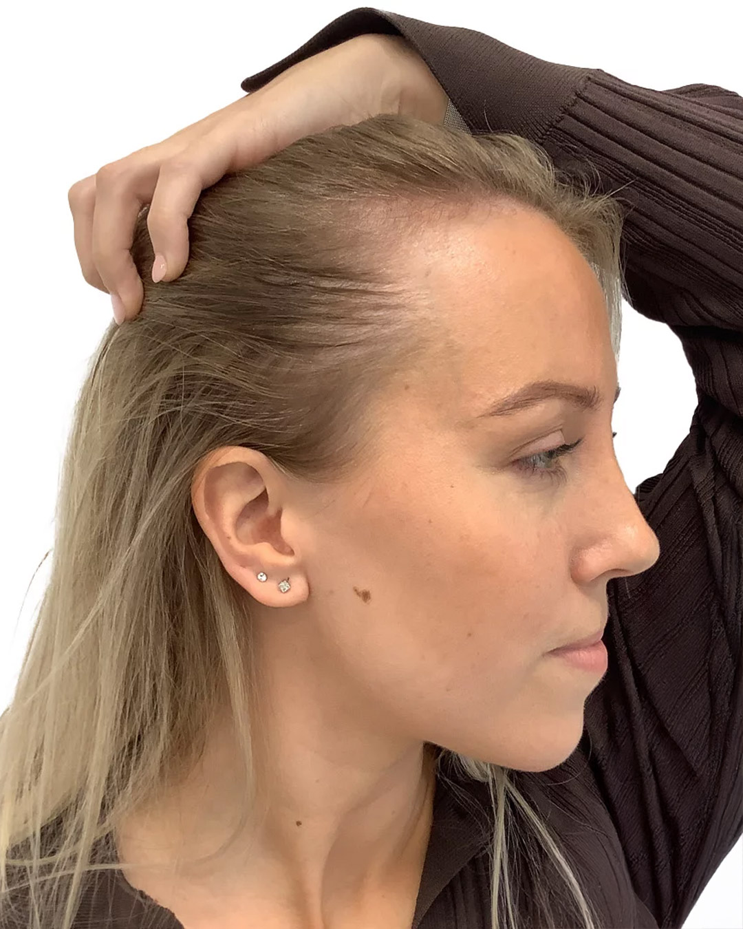 Martina före hårtransplantationen