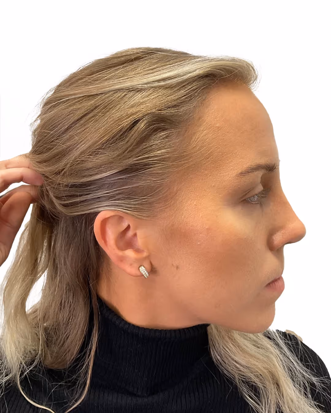 Martina efter hårtransplantationen