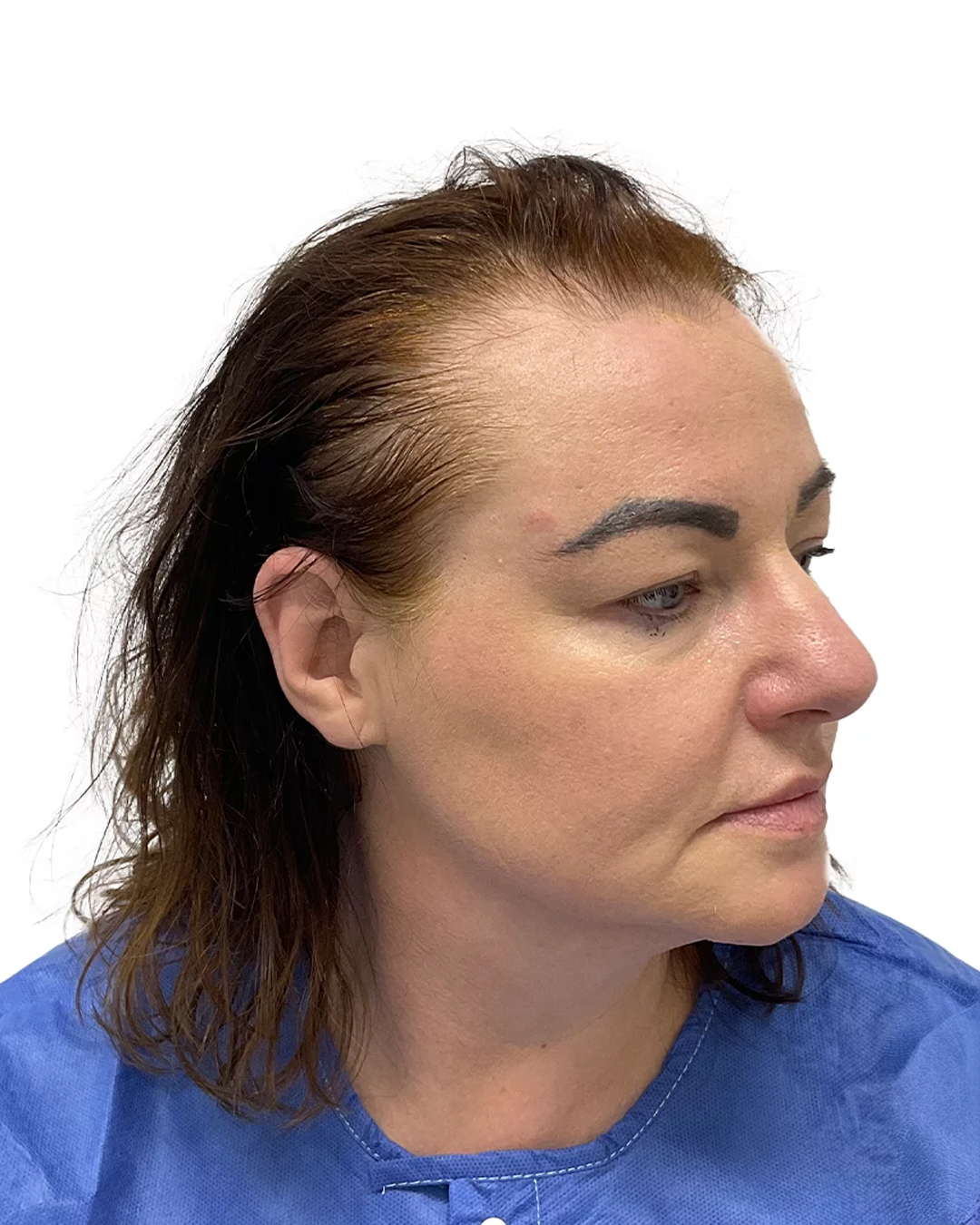 Malou före hårtransplantationen