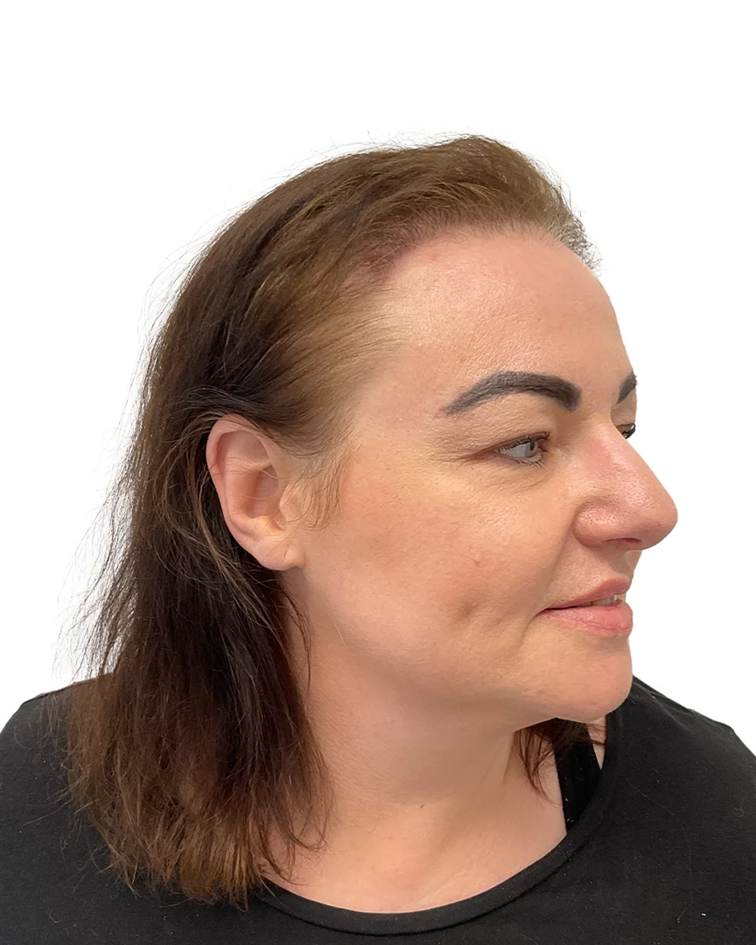 Malou efter hårtransplantationen