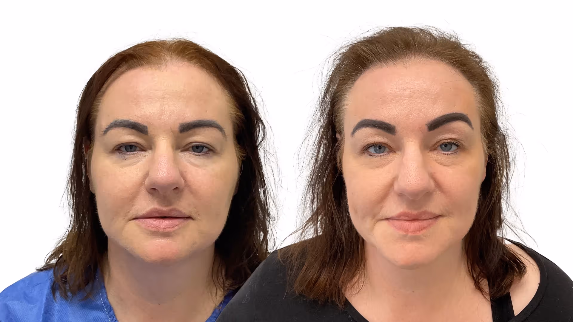Malou – före och efter sin hårtransplantation