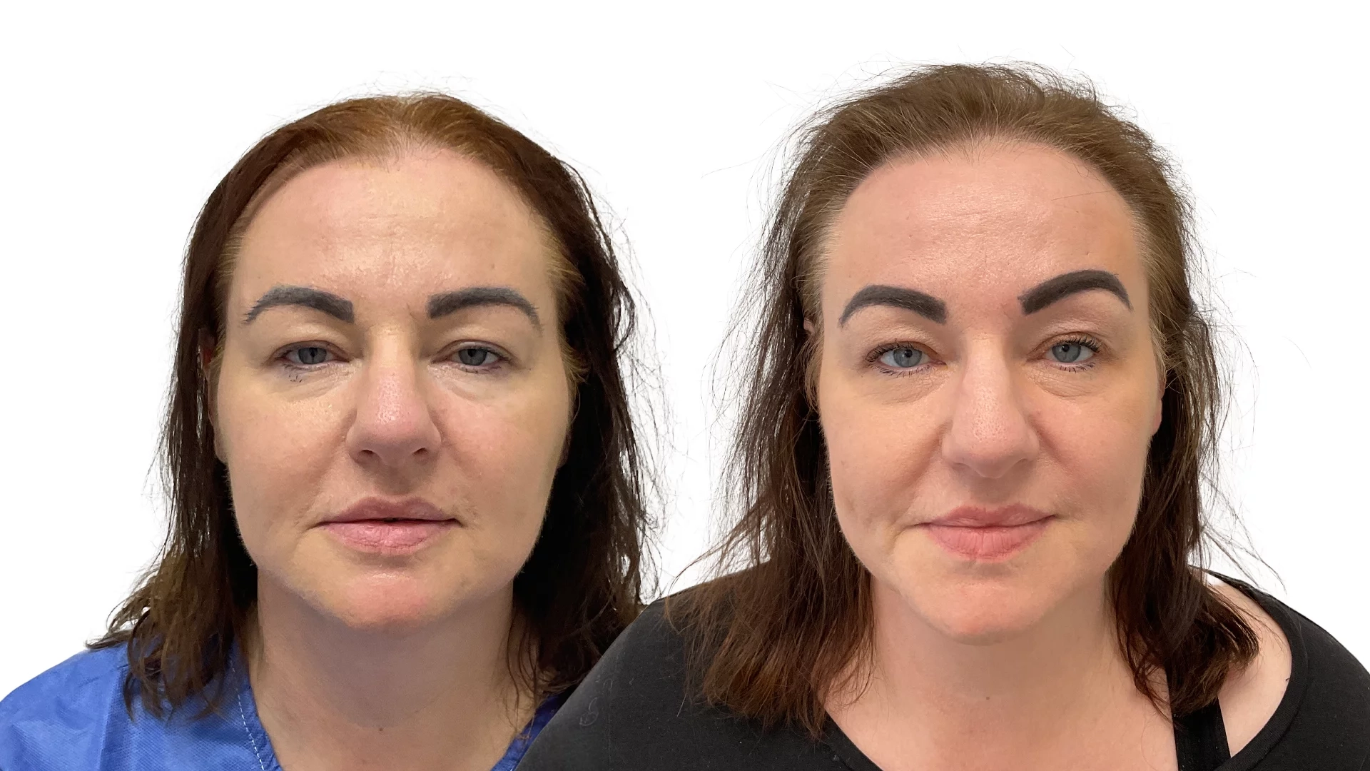 Malou – före och efter sin hårtransplantation