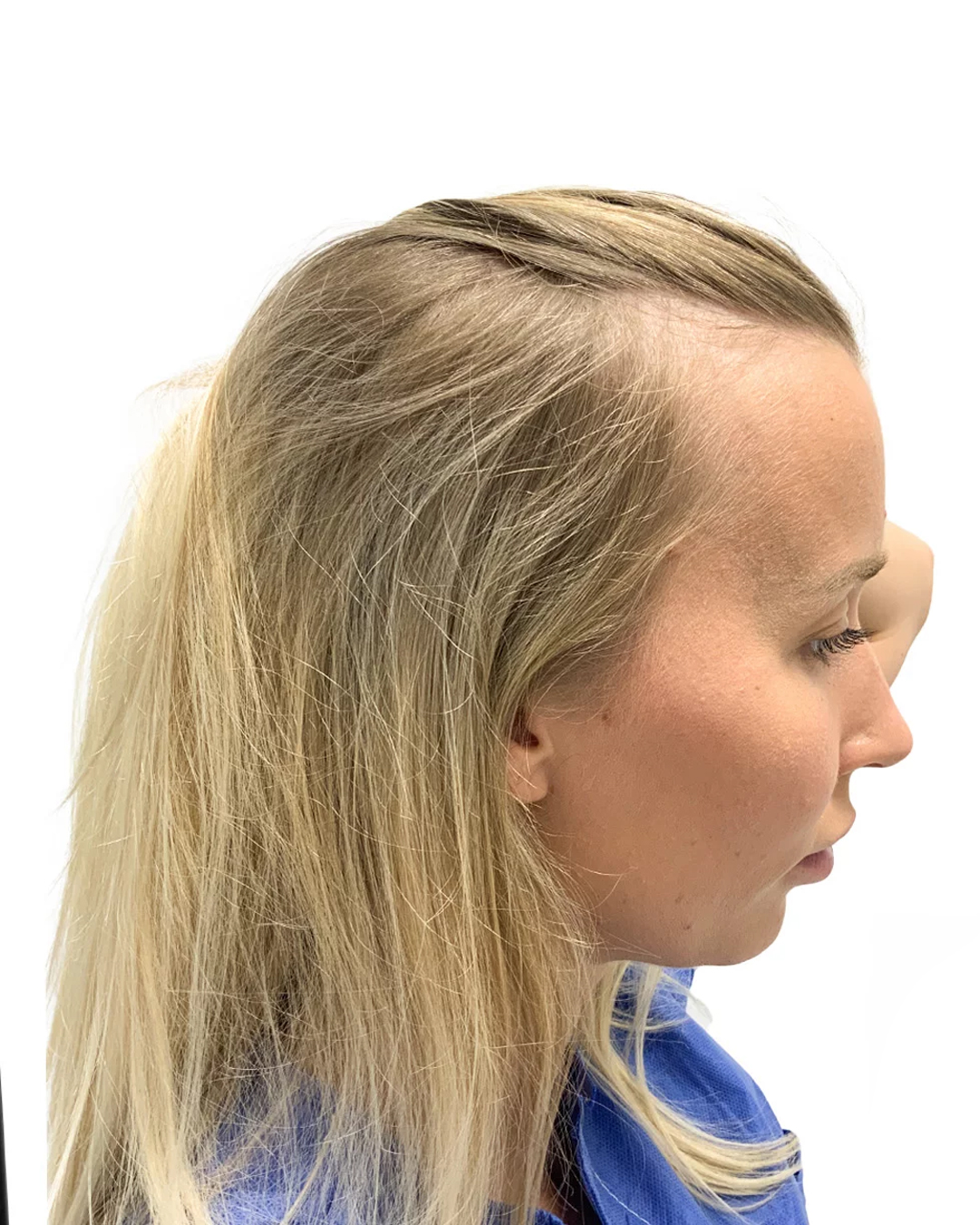 Malin före hårtransplantationen