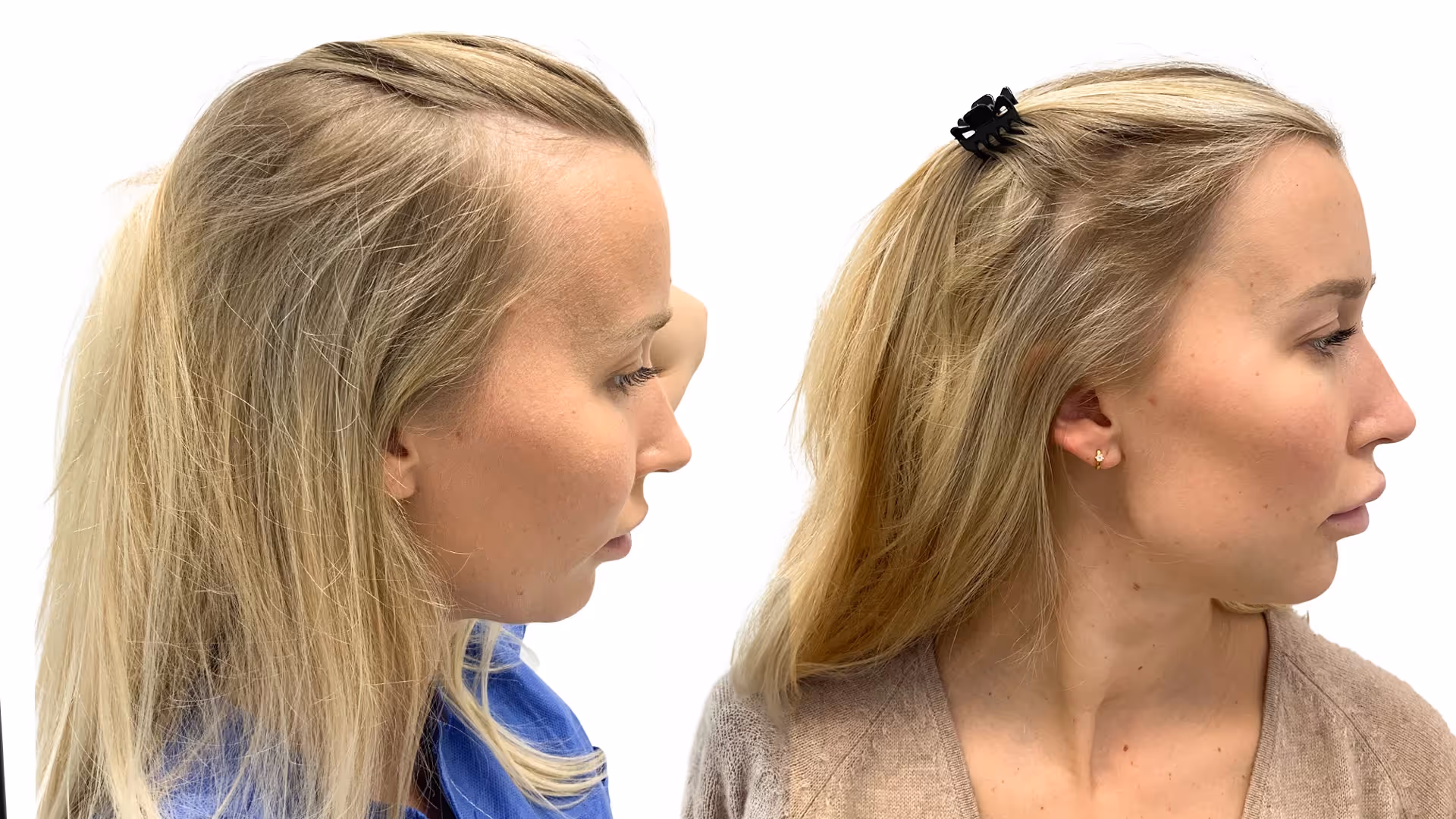 Malin – före och efter sin hårtransplantation