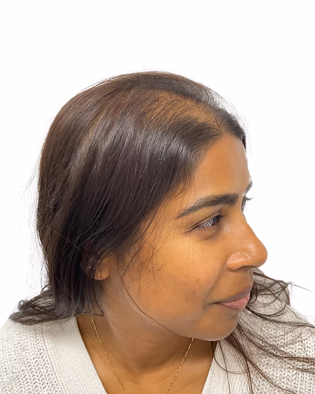 Madelene före hårtransplantationen
