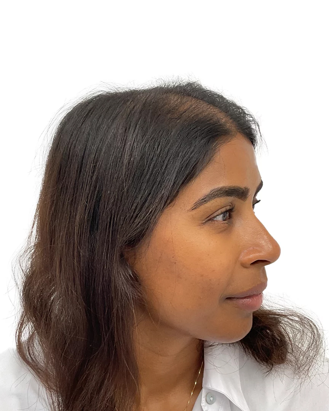 Madelene efter hårtransplantationen