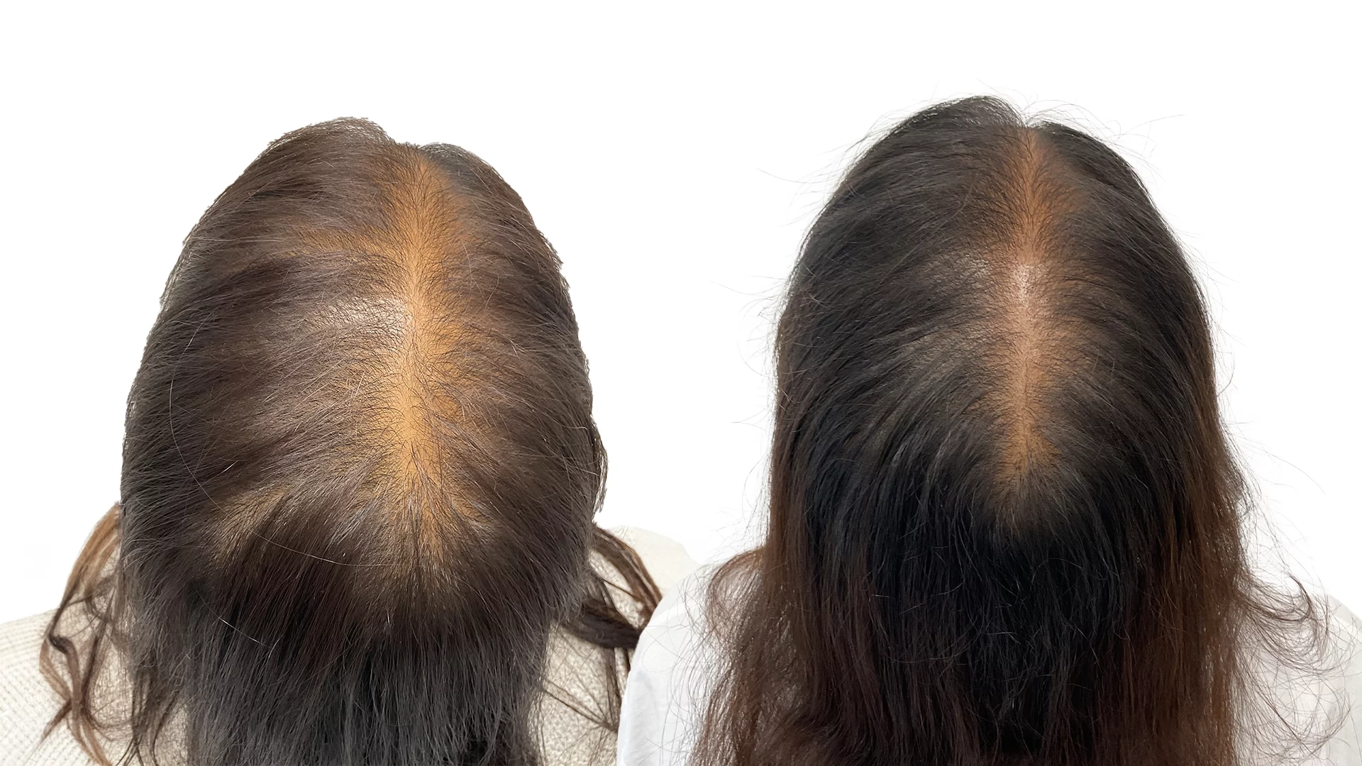 Madelene – före och efter sin hårtransplantation