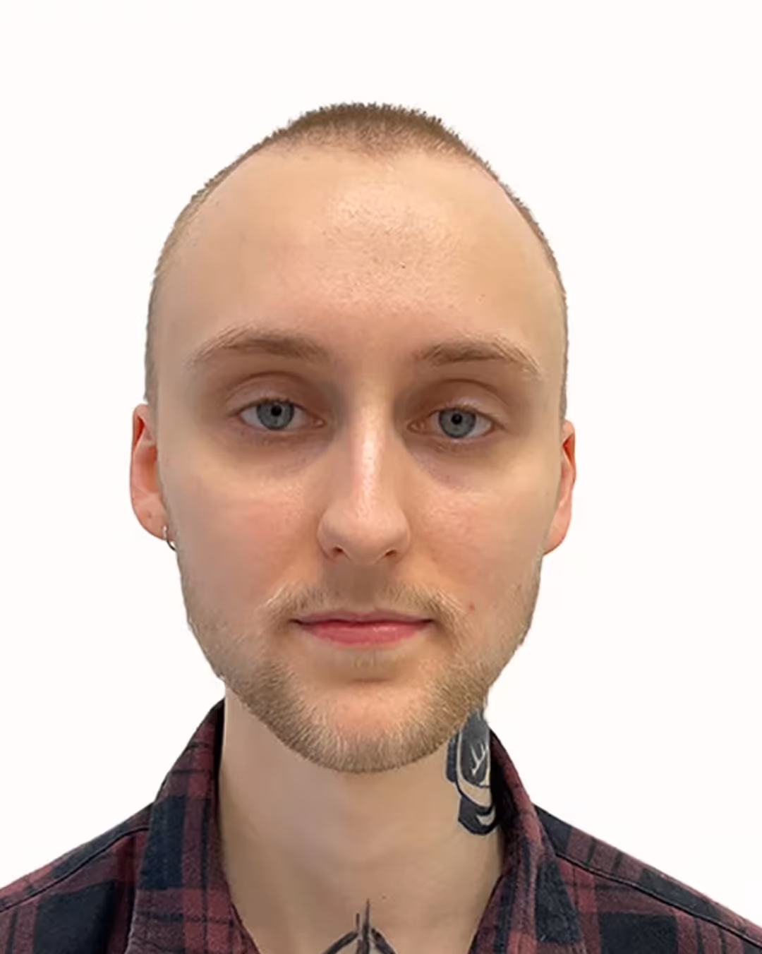 Lucas före skäggtransplantationen