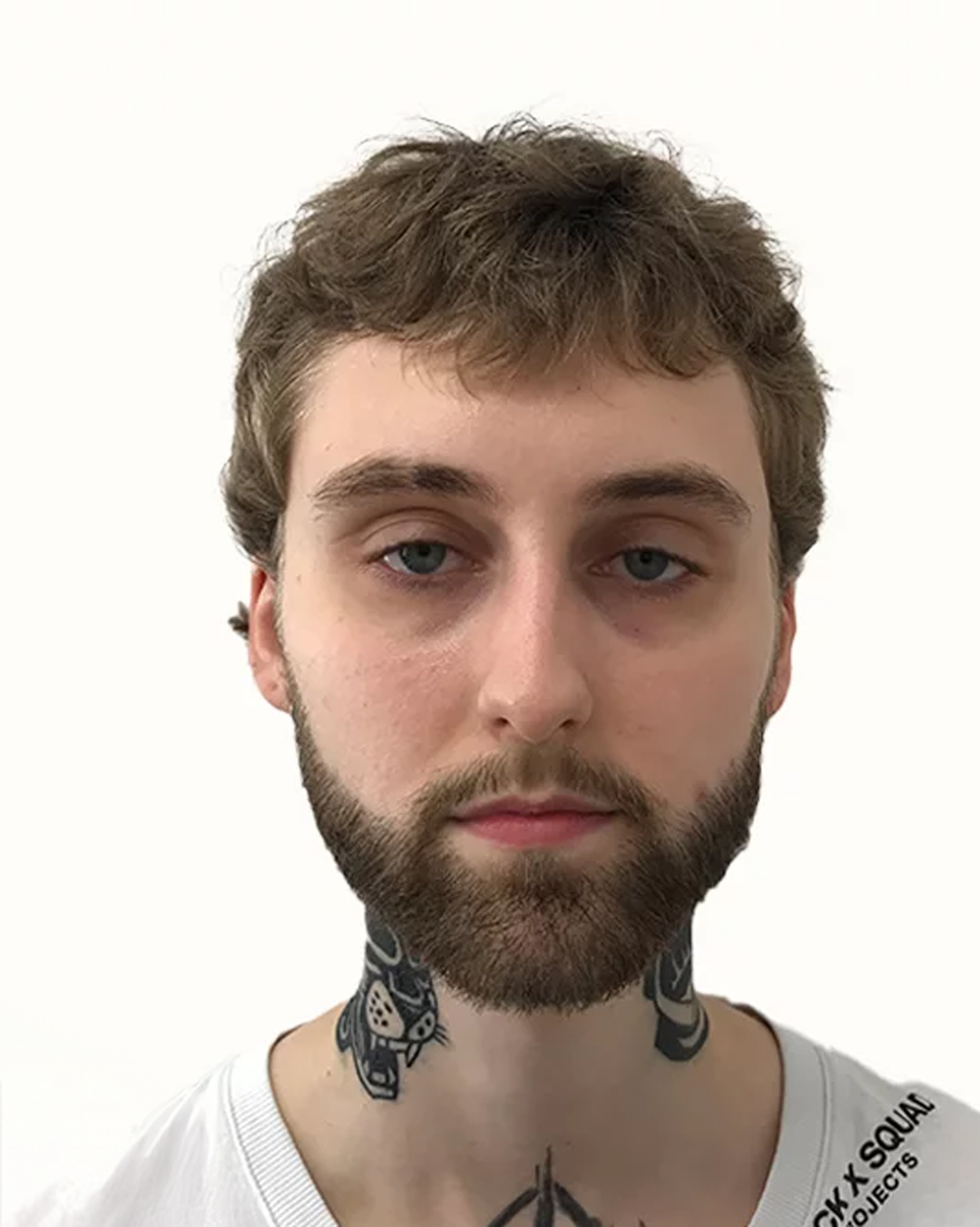 Lucas efter hårtransplantationen