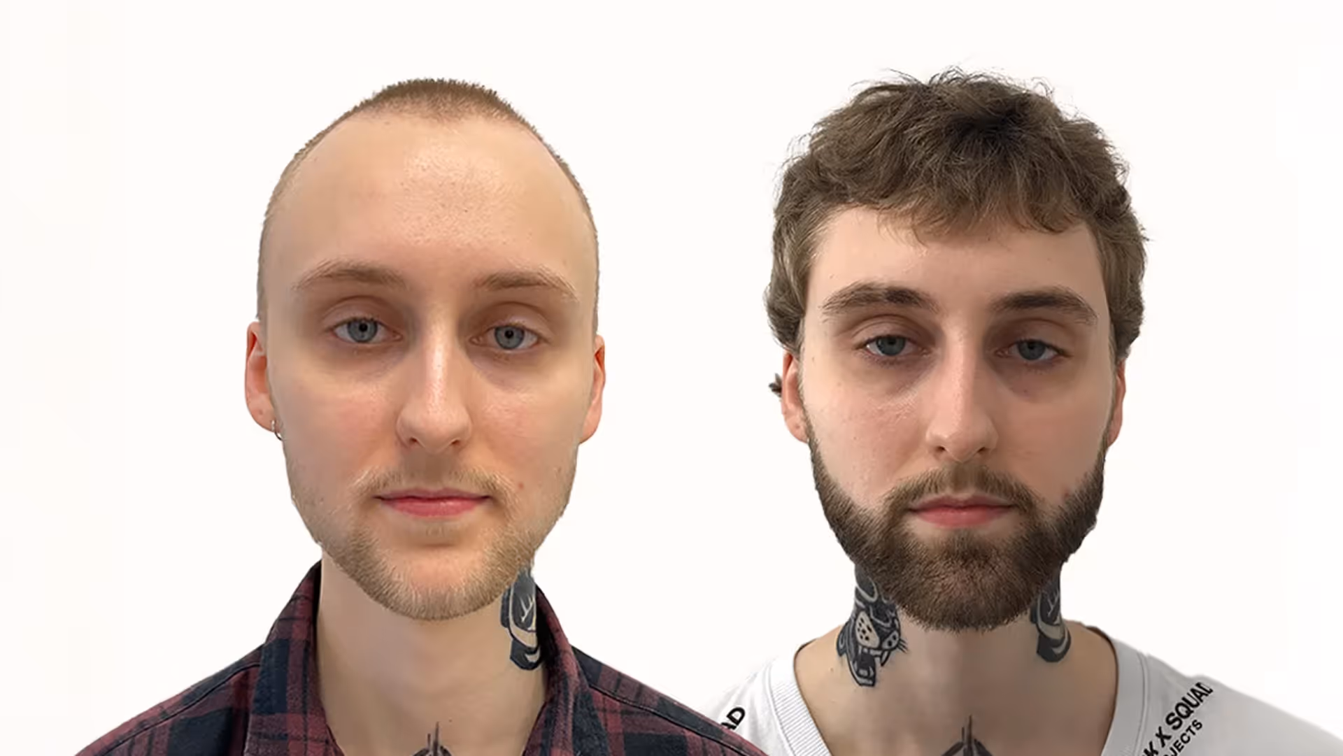 Lucas – före och efter sin skäggtransplantation