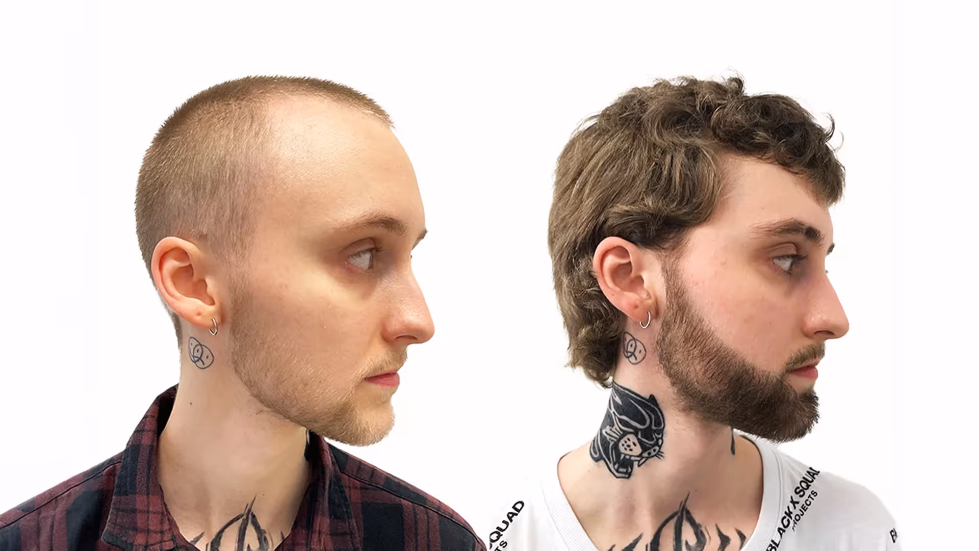 Lucas – före och efter sin skäggtransplantation