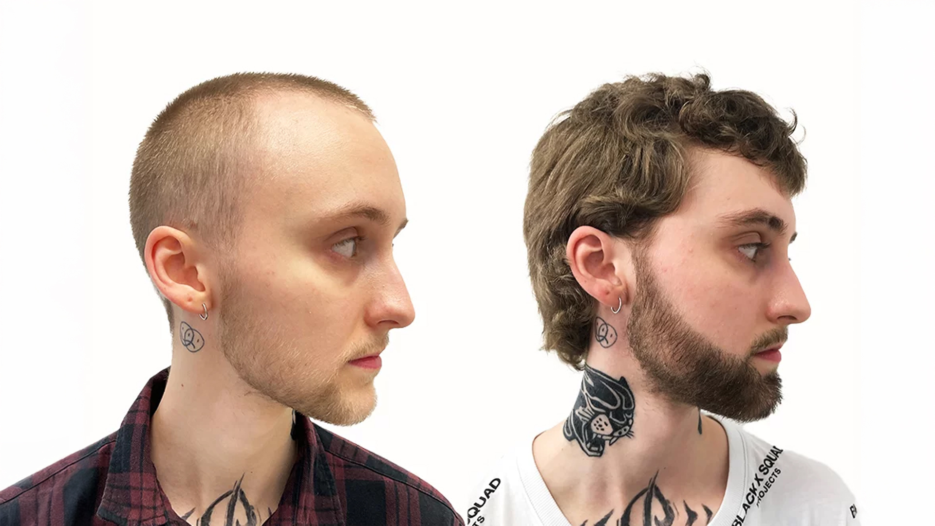 Lucas – före och efter sin skäggtransplantation