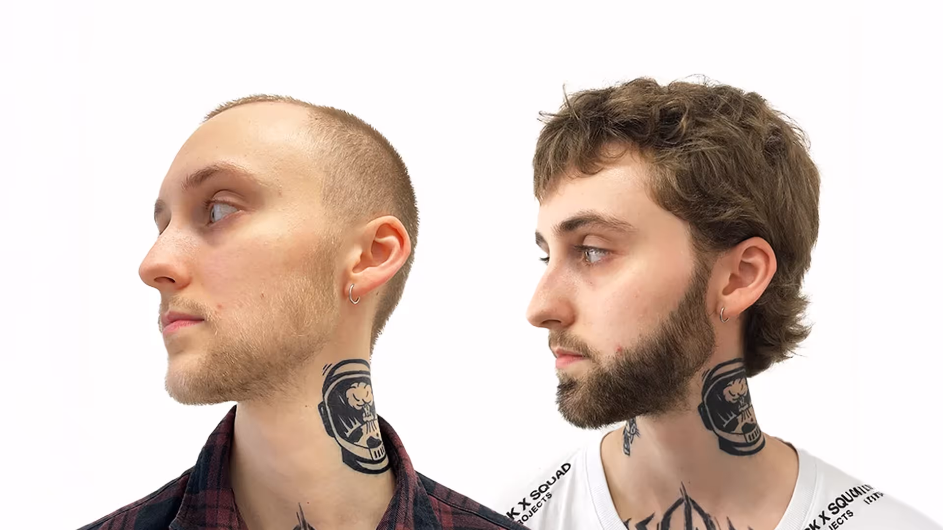 Lucas – före och efter sin skäggtransplantation