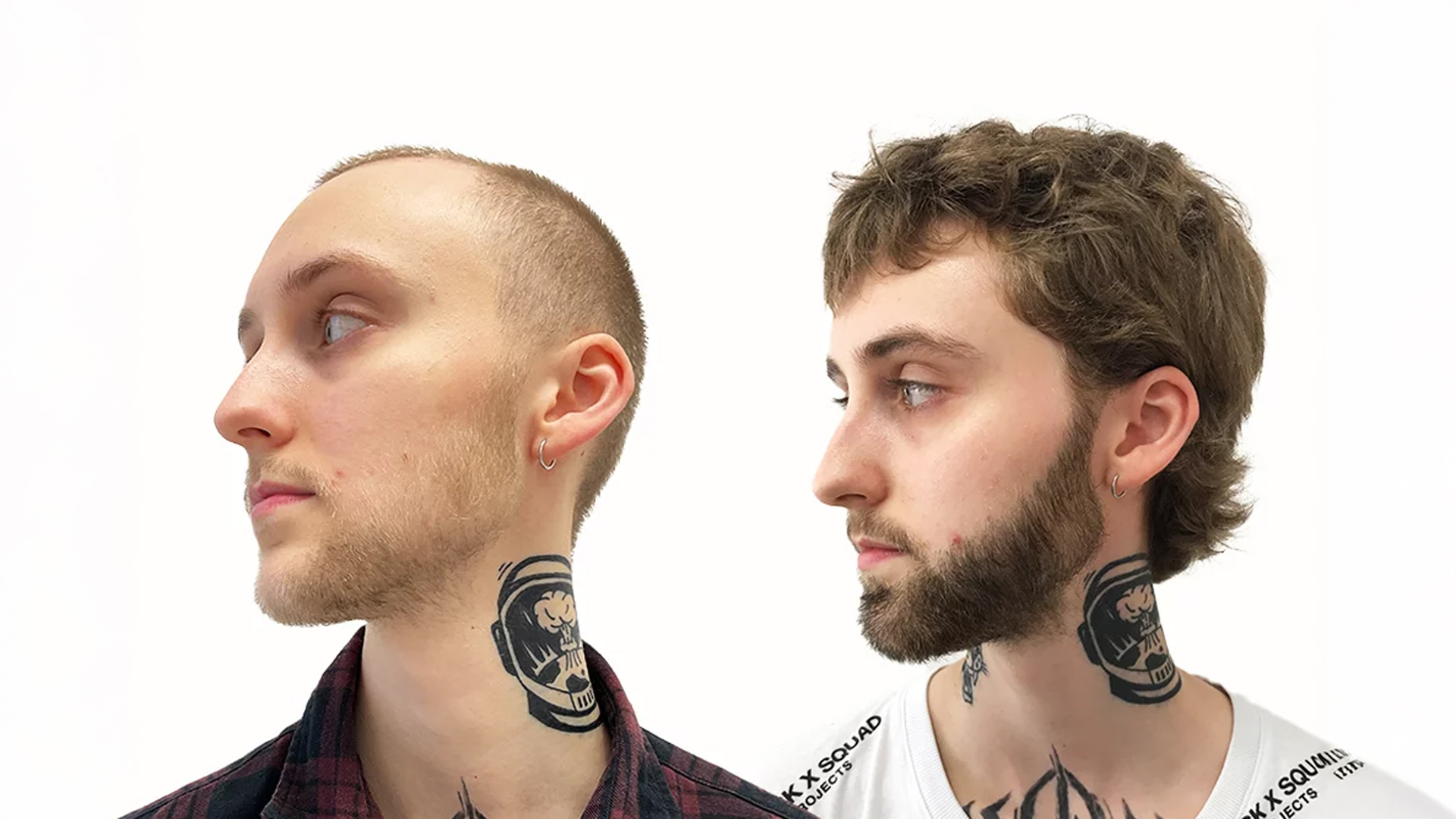 Lucas – före och efter sin skäggtransplantation