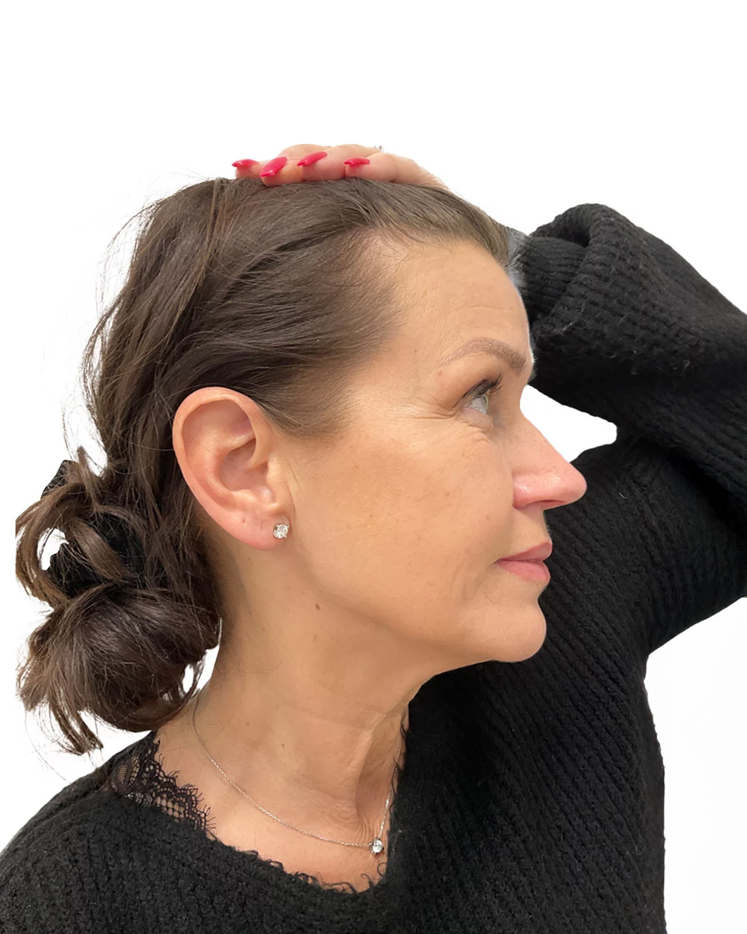 Lena före hårtransplantationen