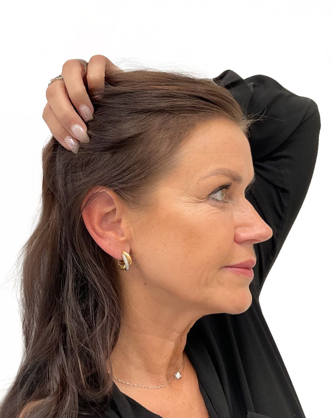 Lena efter hårtransplantationen