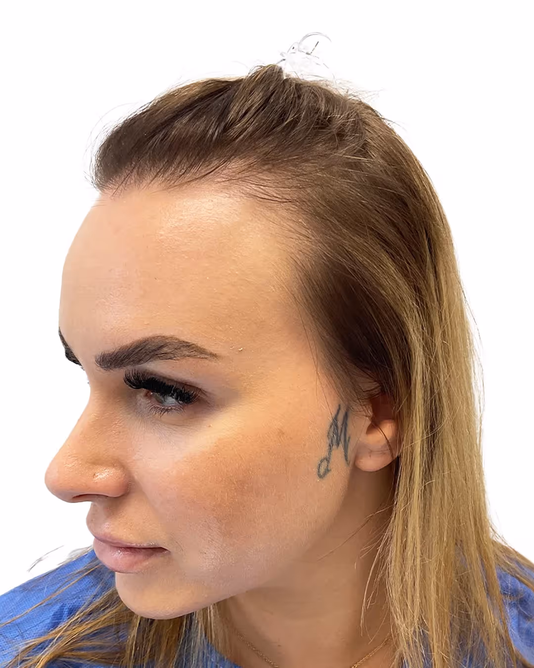 Kristine före hårtransplantationen