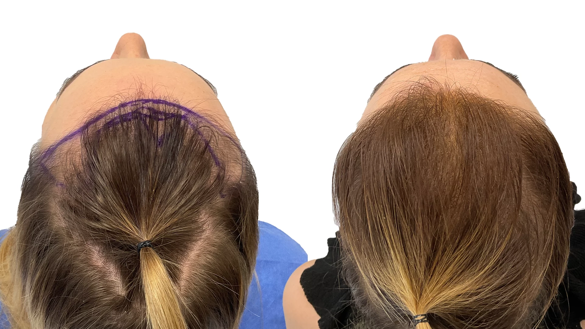 Kristine – före och efter sin hårtransplantation