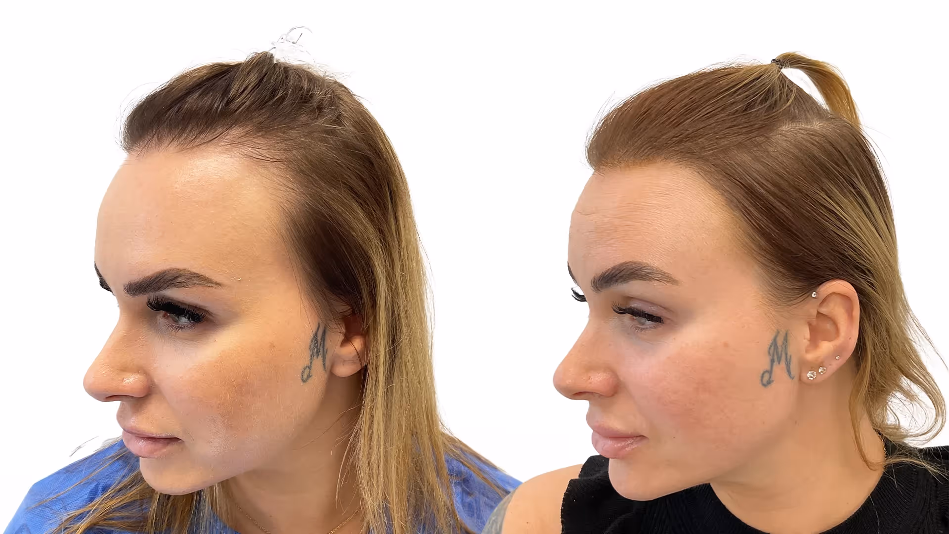 Kristine – före och efter sin hårtransplantation