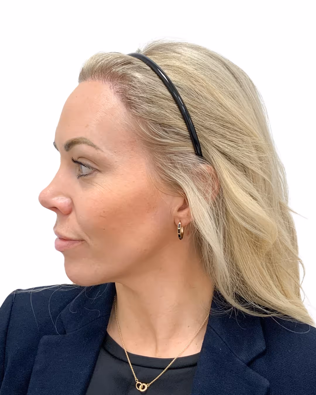 Karin efter hårtransplantationen