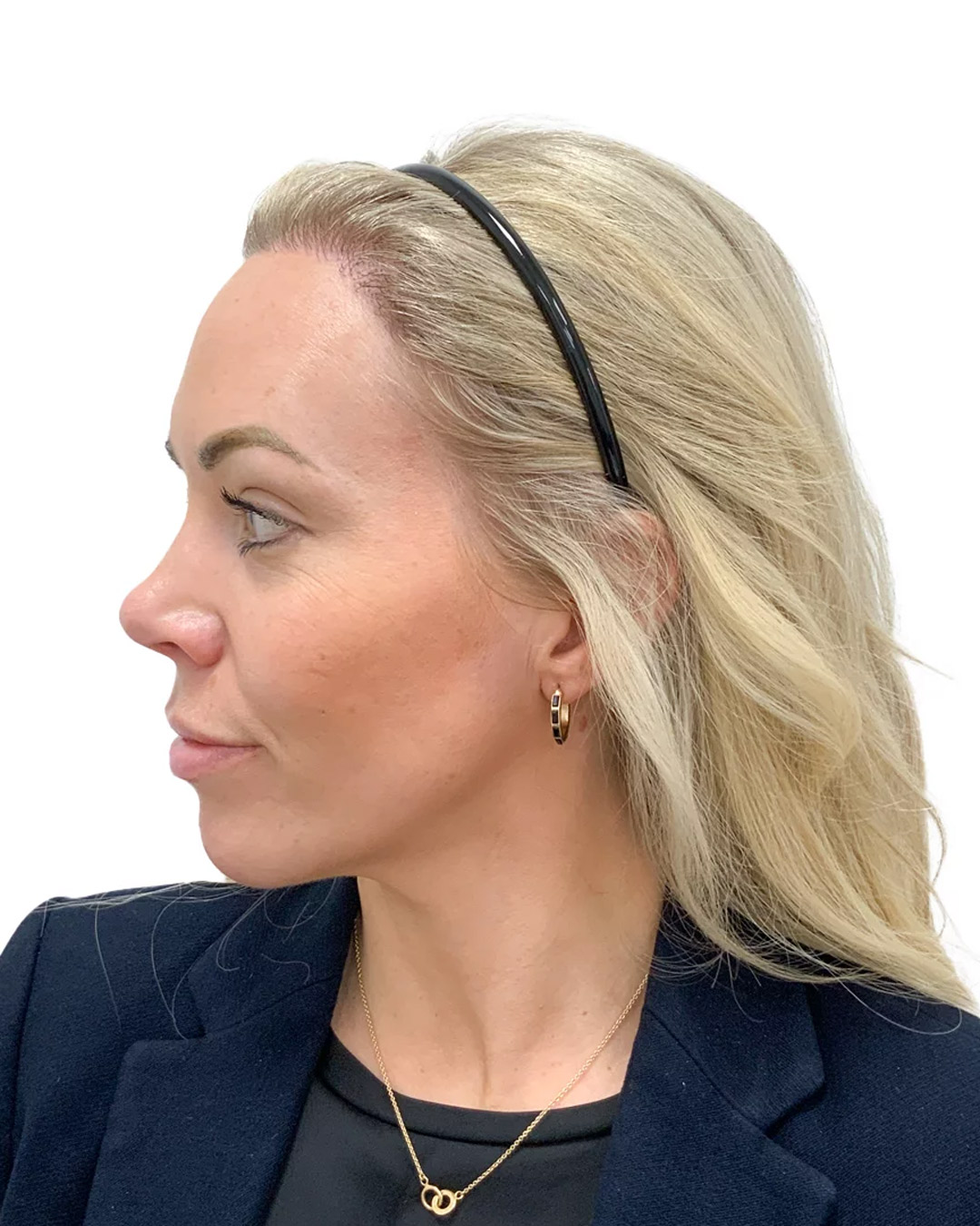 Karin efter hårtransplantationen