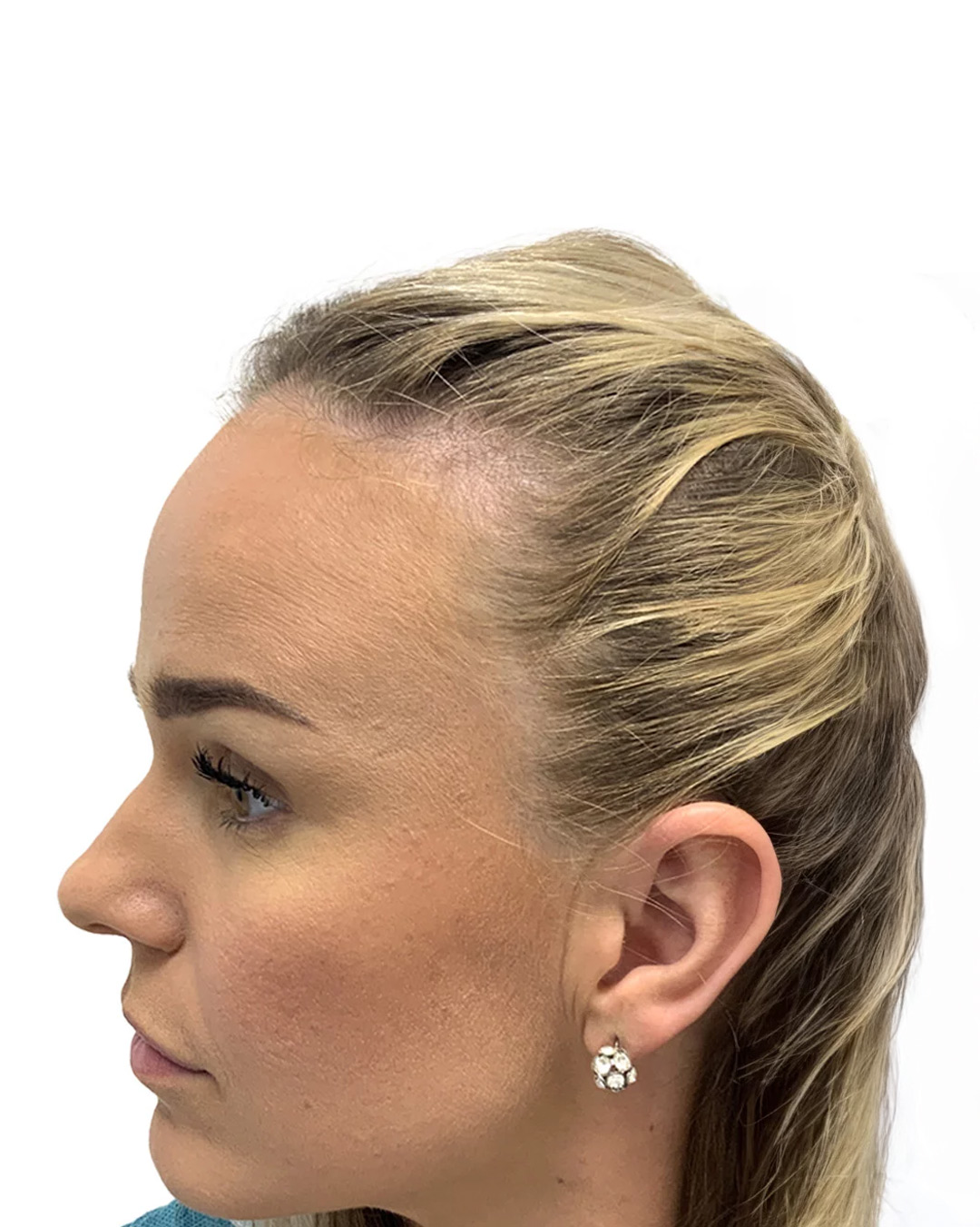 Kajsa före hårtransplantationen