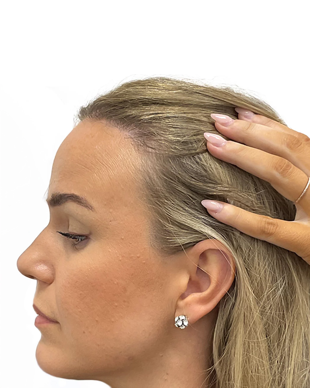 Kajsa efter hårtransplantationen