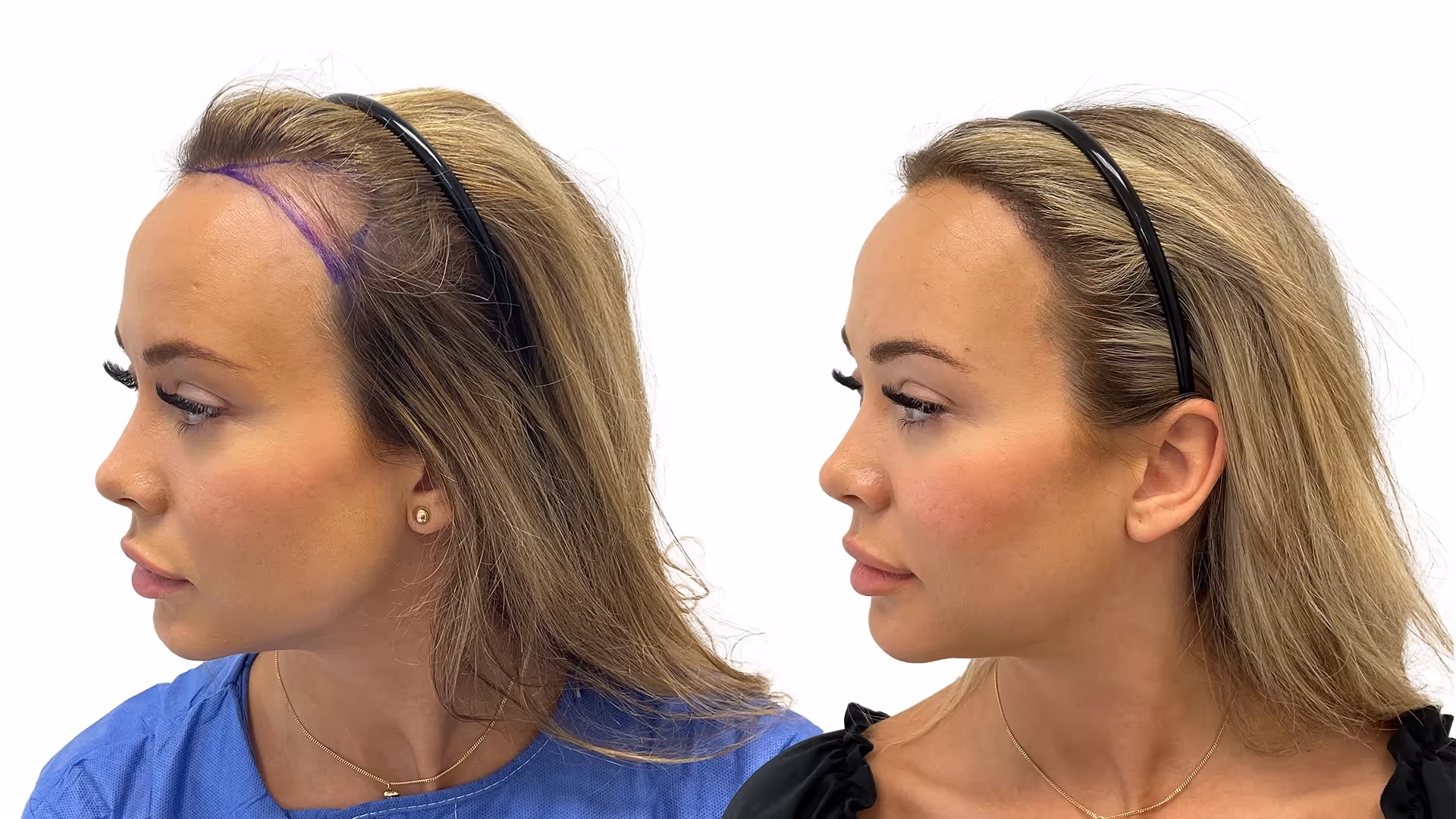 Julia – före och efter sin hårtransplantation