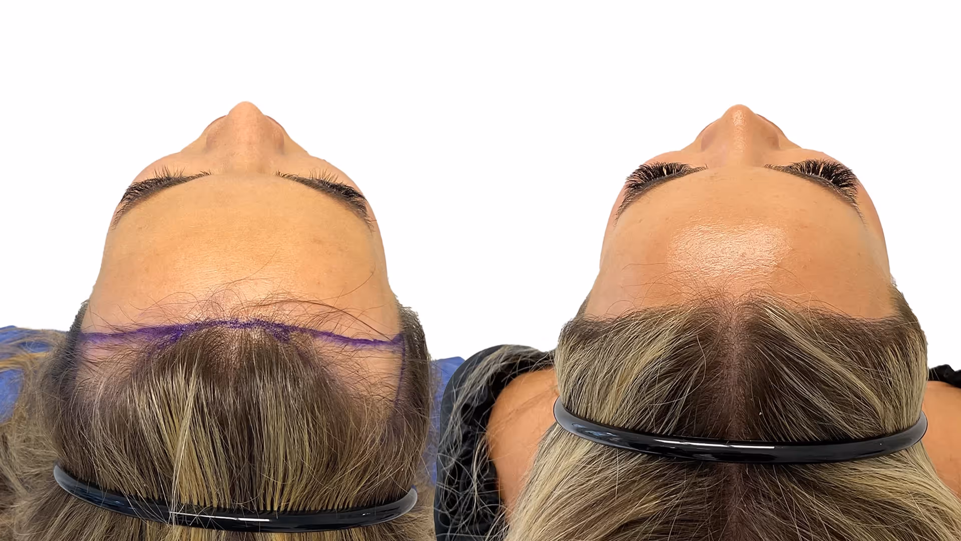 Julia – före och efter sin hårtransplantation