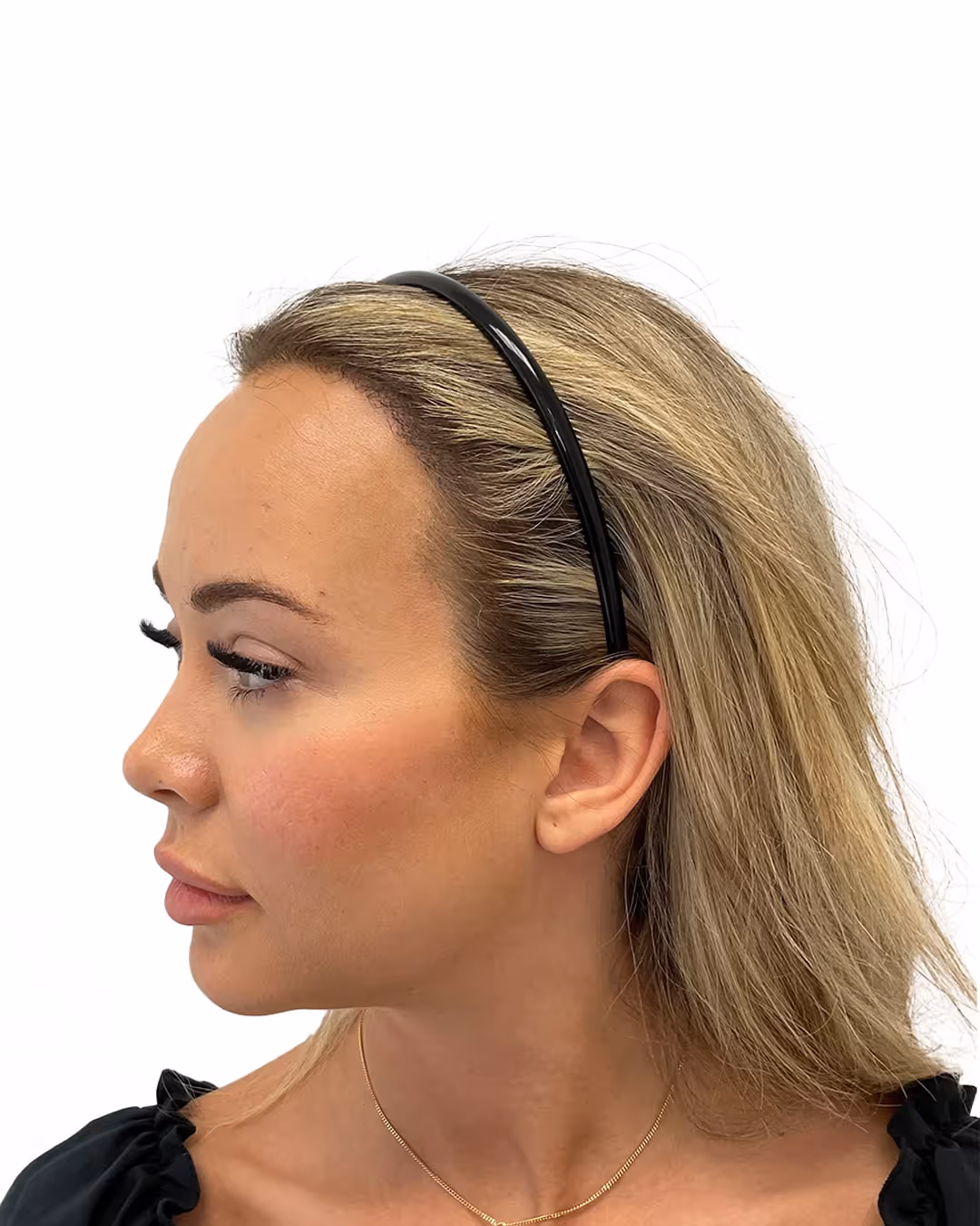 Julia efter hårtransplantationen