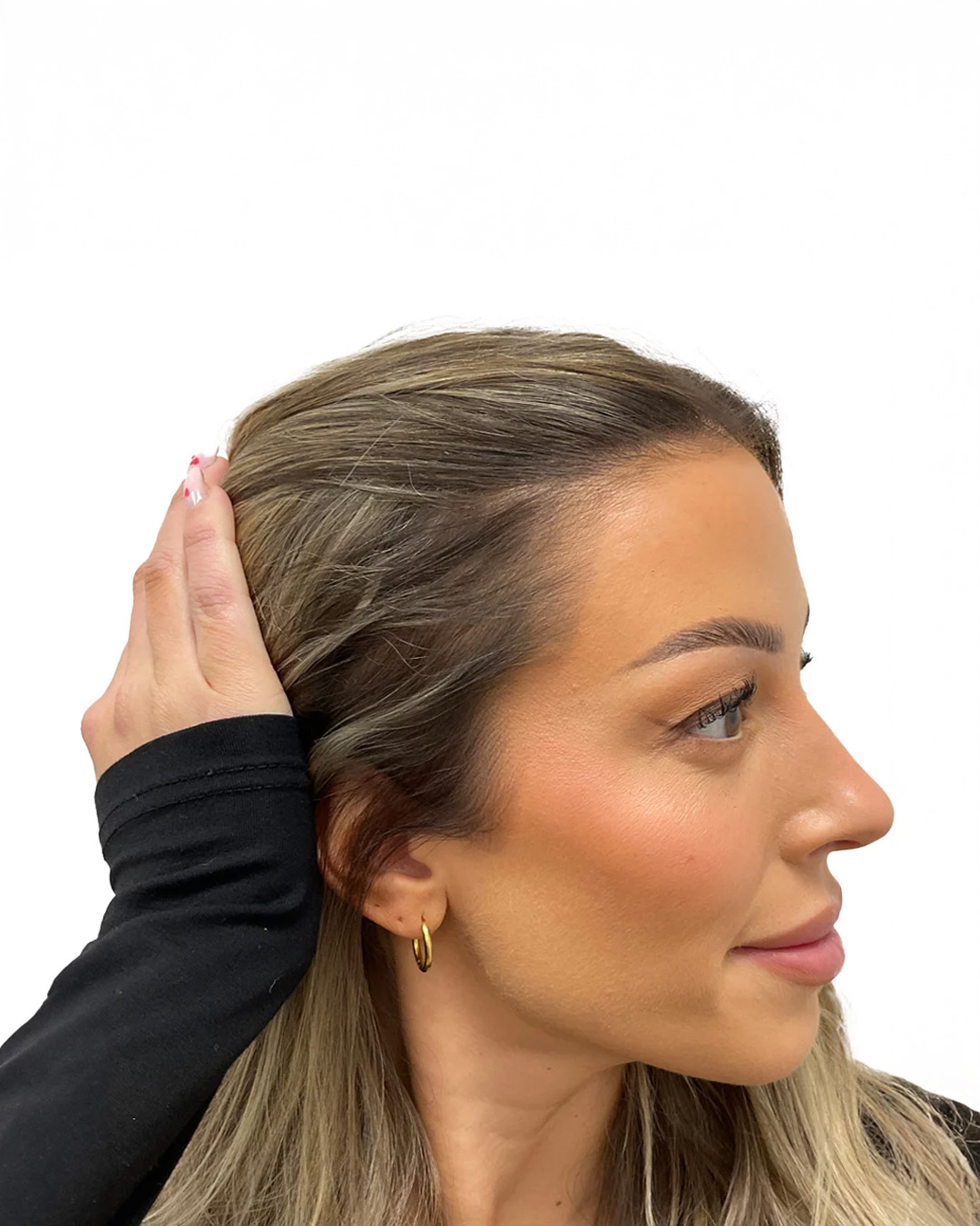 Josephine efter hårtransplantationen